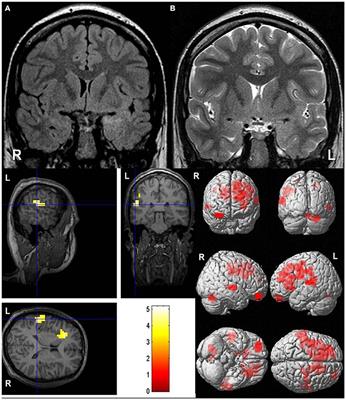 Language Dominance in Patients With Malformations of Cortical Development and Epilepsy